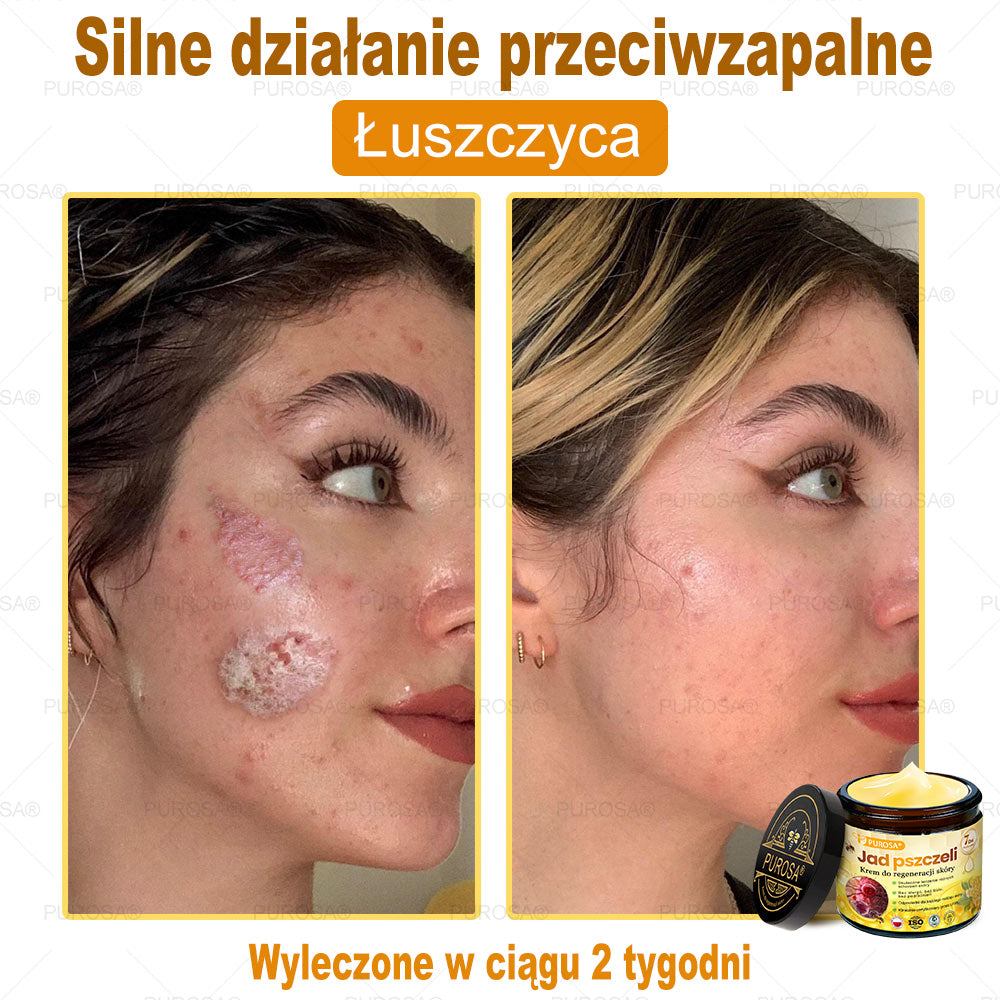 🌟PUROSA® Krem z Jadem Pszczelim do Regeneracji Skóry🐝|Kompleksowe rozwiązanie na uporczywe problemy skórne, takie jak starzenie się, egzema, blizny i łuszczyca