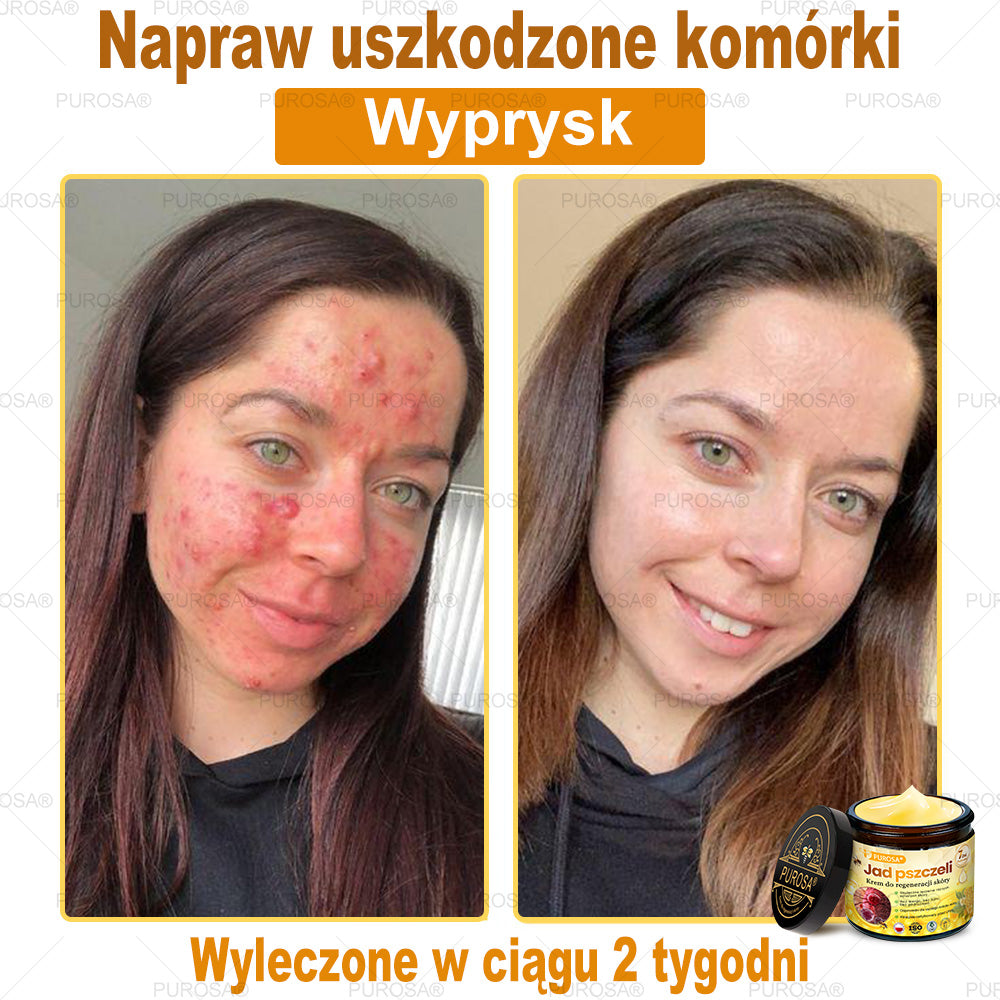 🌟PUROSA® Krem z Jadem Pszczelim do Regeneracji Skóry🐝|Kompleksowe rozwiązanie na uporczywe problemy skórne, takie jak starzenie się, egzema, blizny i łuszczyca
