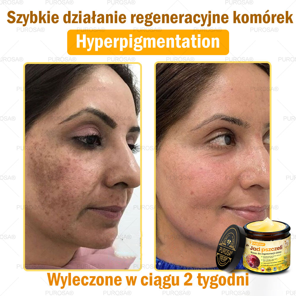 🌟PUROSA® Krem z Jadem Pszczelim do Regeneracji Skóry🐝|Kompleksowe rozwiązanie na uporczywe problemy skórne, takie jak starzenie się, egzema, blizny i łuszczyca